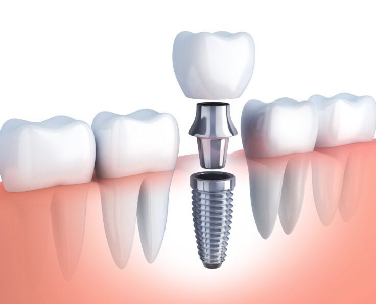 implant-diagram