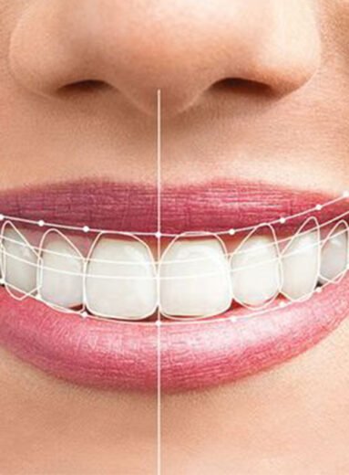 665b389dbd3db72ba1e04264_Smile-Makeover-blog